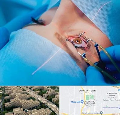 عمل prk چشم در اکباتان 