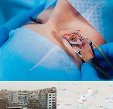 عمل prk چشم در محمد شهر کرج 