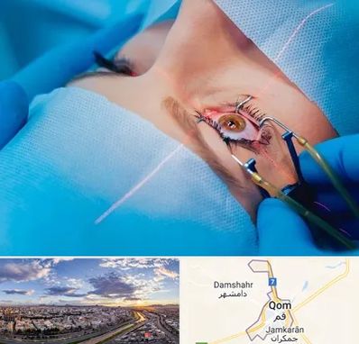 عمل prk چشم در قم