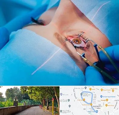 عمل prk چشم در بلوار گیلان رشت