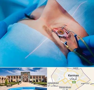 عمل prk چشم در کرمان