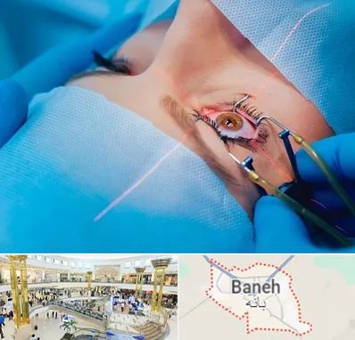 عمل prk چشم در بانه