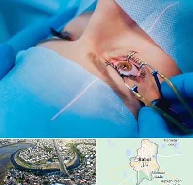 عمل prk چشم در بابل