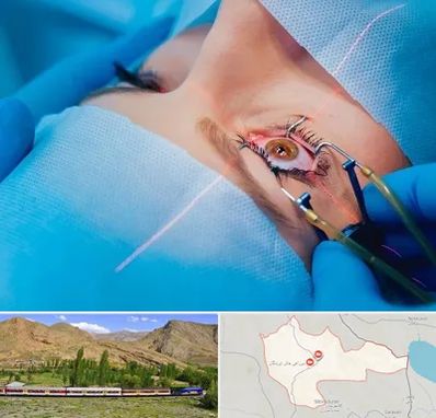 عمل prk چشم در خاش