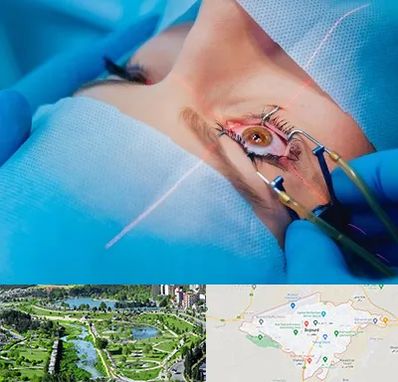 عمل prk چشم در بجنورد