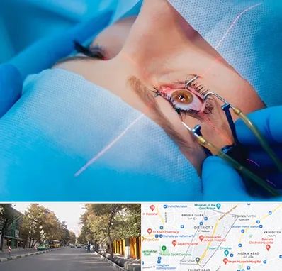 عمل prk چشم در شریعتی 