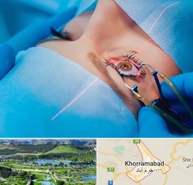 عمل prk چشم در خرم آباد