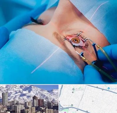 عمل prk چشم در ازگل