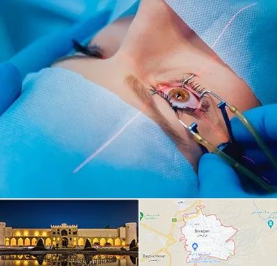 عمل prk چشم در برازجان