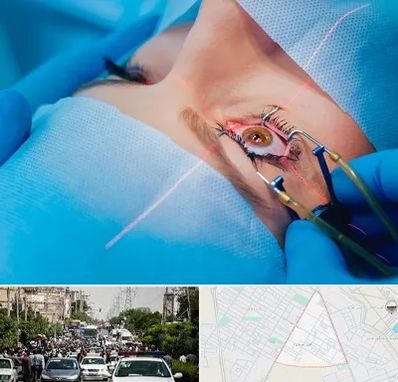 عمل prk چشم در سیدی مشهد