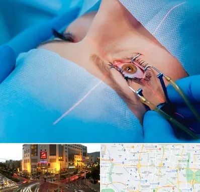 عمل prk چشم در جنت آباد تهران 