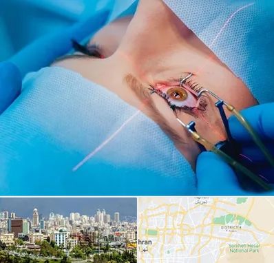 عمل prk چشم در شرق تهران 