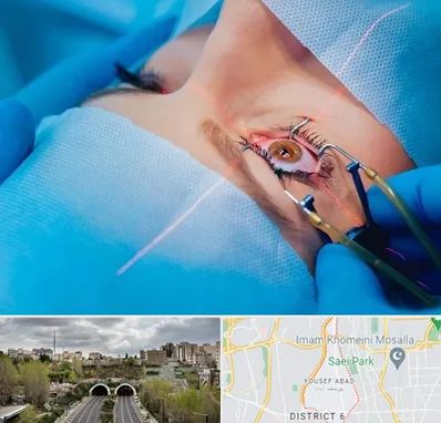 عمل prk چشم در یوسف آباد 