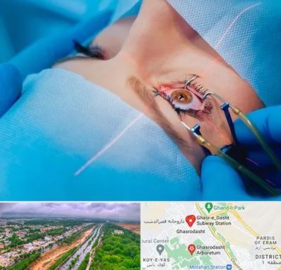 عمل prk چشم در قصرالدشت شیراز