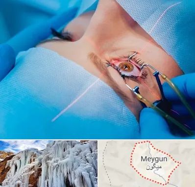 عمل prk چشم در میگون