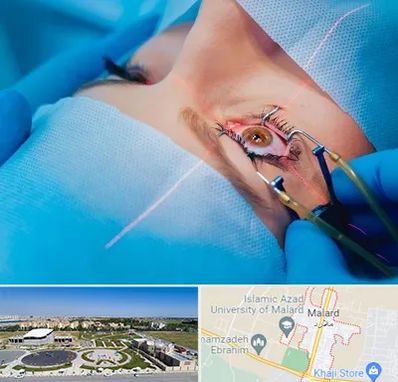 عمل prk چشم در ملارد