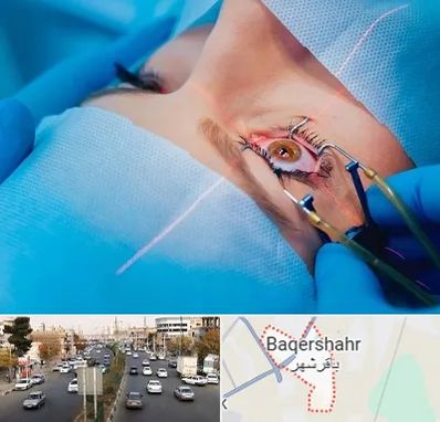 عمل prk چشم در باقرشهر