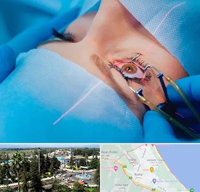 عمل prk چشم در رودسر