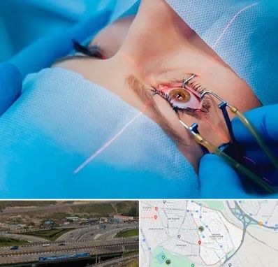 عمل prk چشم در یاغچیان تبریز