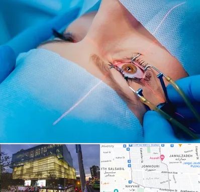 عمل prk چشم در جمهوری 