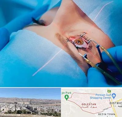 عمل prk چشم در شهرک گلستان شیراز
