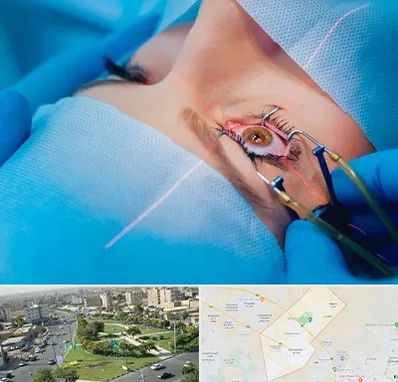 عمل prk چشم در کمال شهر کرج 