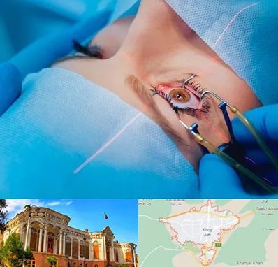 عمل prk چشم در خوی