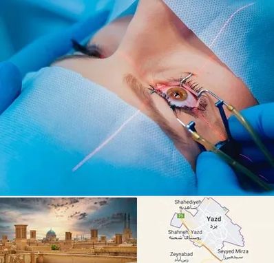 عمل prk چشم در یزد