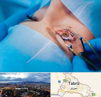 عمل prk چشم در تبریز