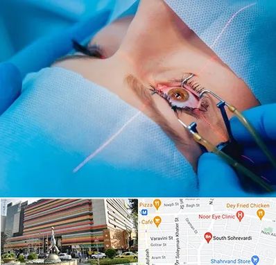 عمل prk چشم در سهروردی 