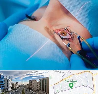 عمل prk چشم در سعادت آباد 