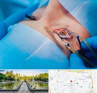 عمل prk چشم در سرسبز 