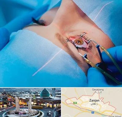 عمل prk چشم در زنجان