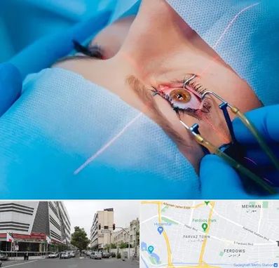 عمل prk چشم در بلوار فردوس 