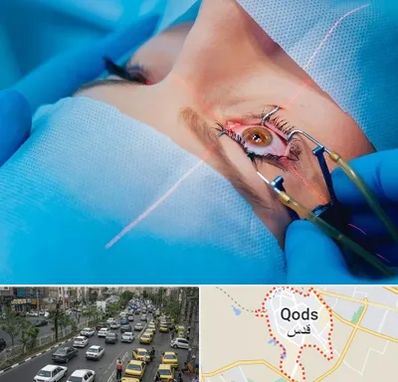 عمل prk چشم در شهر قدس