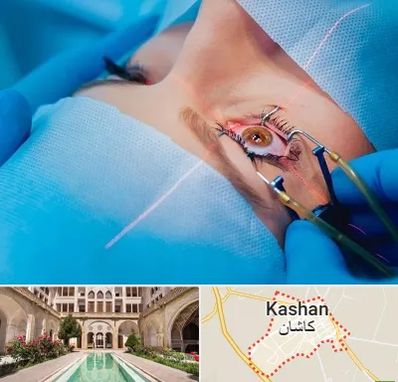 عمل prk چشم در کاشان