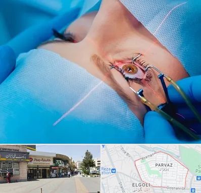 عمل prk چشم در پرواز تبریز