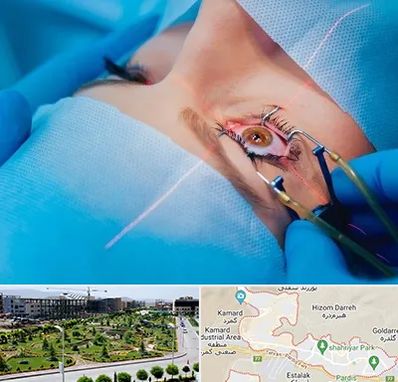 عمل prk چشم در پردیس