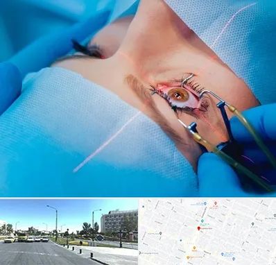 عمل prk چشم در بلوار کلاهدوز مشهد 