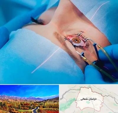 عمل prk چشم در خراسان شمالی