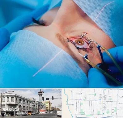 عمل prk چشم در 17شهریور