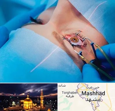 عمل prk چشم در مشهد