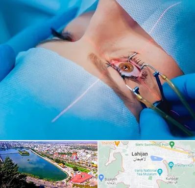 عمل prk چشم در لاهیجان