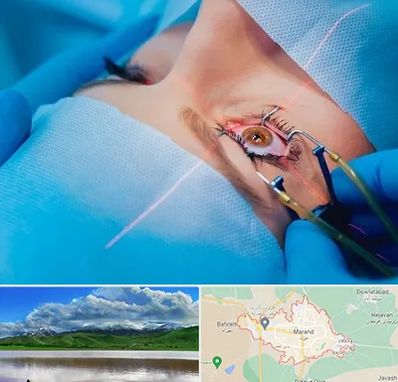 عمل prk چشم در مرند