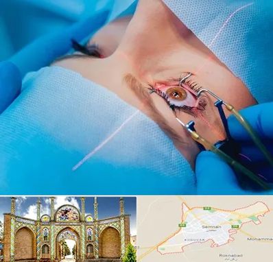 عمل prk چشم در سمنان