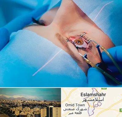 عمل prk چشم در اسلامشهر