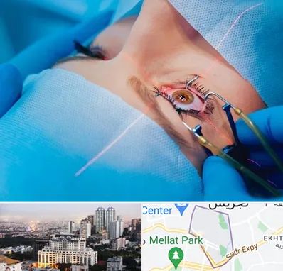 عمل prk چشم در الهیه 