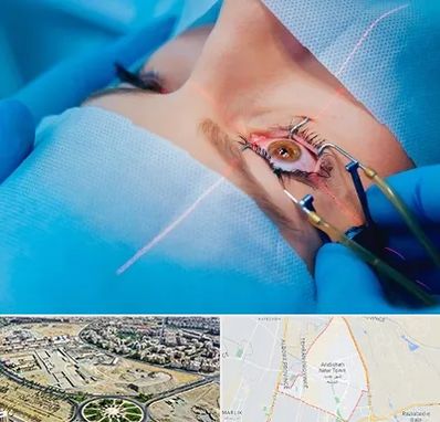 عمل prk چشم در اندیشه