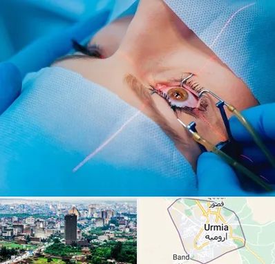 عمل prk چشم در ارومیه