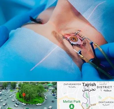 عمل prk چشم در تجریش 